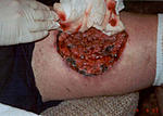 Click image for larger version

Name:	brown-recluse-spider-bite-9days.jpg
Views:	73
Size:	18.0 KB
ID:	199800