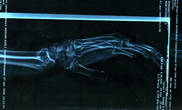 Name:  leftwrist1-1.jpg
Views: 18
Size:  36.5 KB