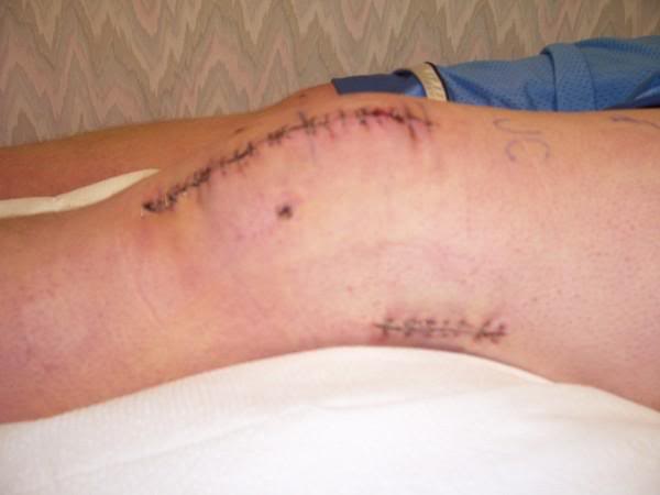 Name:  Knee3.jpg
Views: 185
Size:  17.7 KB