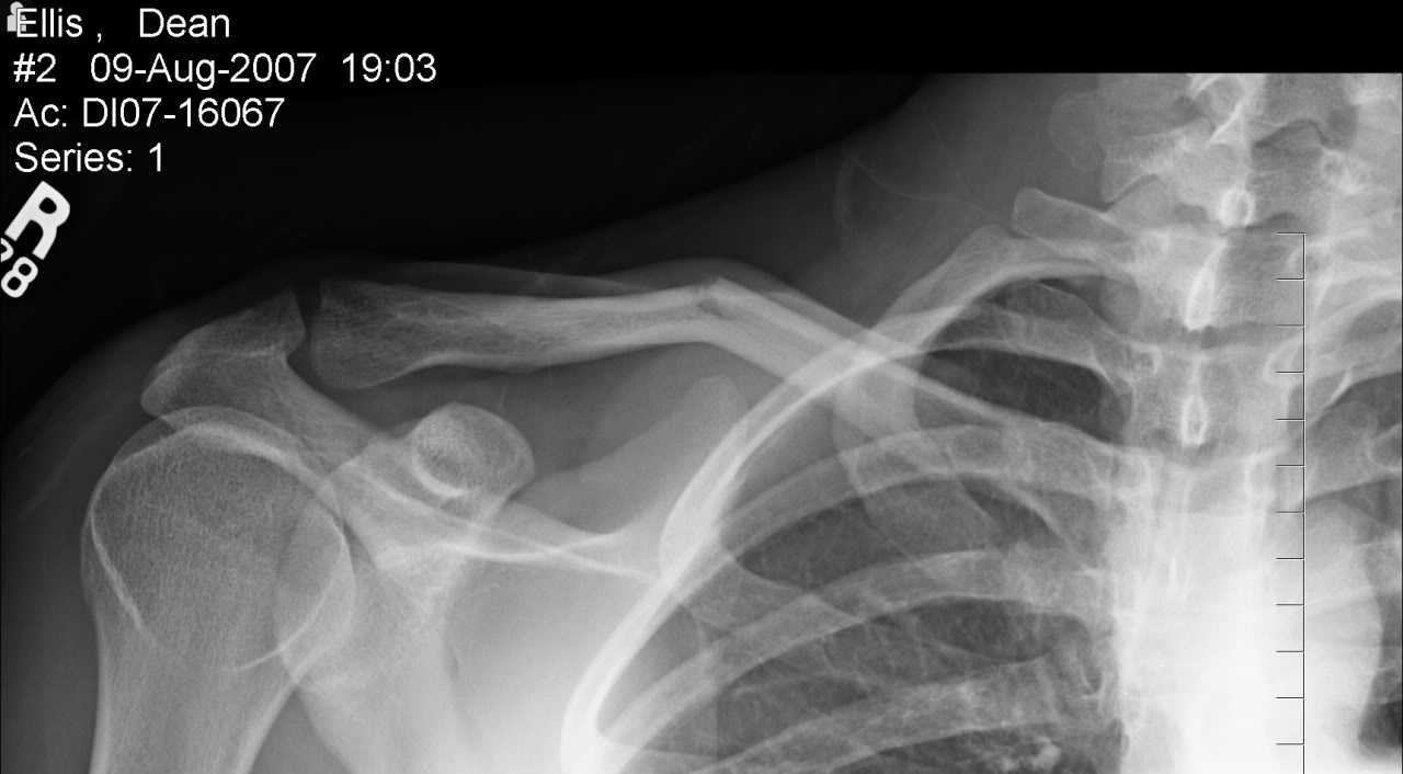 Name:  rightclavicleb.jpg
Views: 11
Size:  74.9 KB