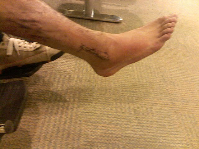 Name: VernsLegInjury006.jpg
Views: 16
Size: 53.0 KB