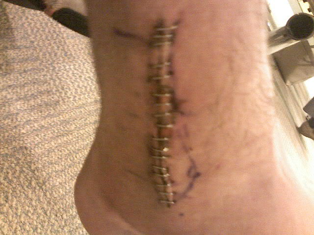 Name: VernsLegInjury005.jpg
Views: 17
Size: 52.8 KB