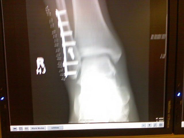 Name: VernsLegInjury001.jpg
Views: 14
Size: 31.1 KB