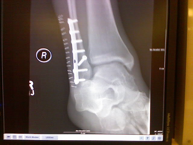 Name:  VernsLegInjury002.jpg
Views: 13
Size:  33.8 KB