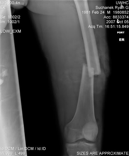 Name:  femur.jpg
Views: 15
Size:  24.2 KB