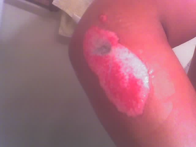 Name:  rash.jpg
Views: 24
Size:  13.5 KB