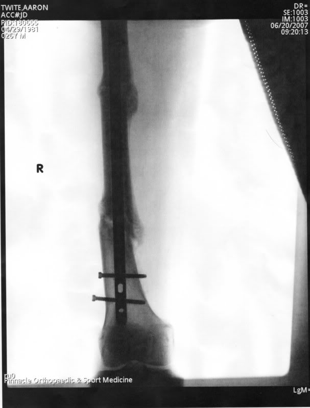 Name:  FemurX-Ray2_0002.jpg
Views: 9
Size:  32.7 KB