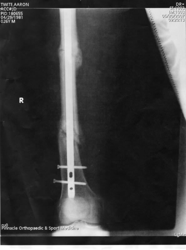 Name:  FemurX-Ray1.jpg
Views: 10
Size:  33.6 KB