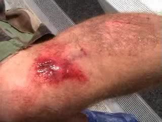 Name:  wound1.jpg
Views: 6
Size:  14.5 KB