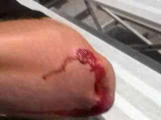 Name:  wound2.jpg
Views: 6
Size:  8.6 KB