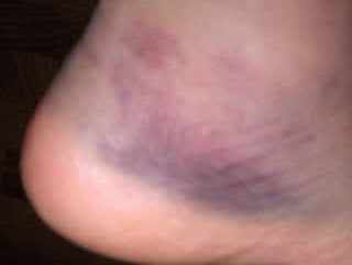 Name:  brokefoot002.jpg
Views: 15
Size:  6.4 KB