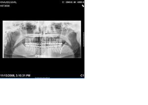 Click image for larger version

Name:	Jaw.bmp
Views:	26
Size:	2.99 MB
ID:	325704