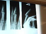 Click image for larger version

Name:	megs finger xray.jpg
Views:	488
Size:	12.3 KB
ID:	37961